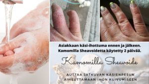 auttaa jatkuvan käsienpesun aiheuttamaan ihon kuivumiseen