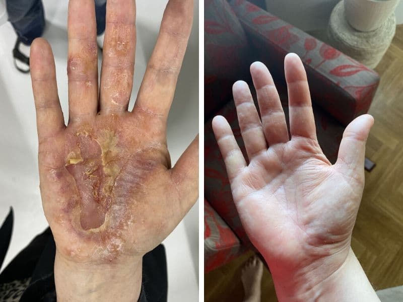 Ennen ja jälkeen kuvat todella pahasta käsi-ihottumasta joka on parantunut Saaren Taika Teepuusaippualla