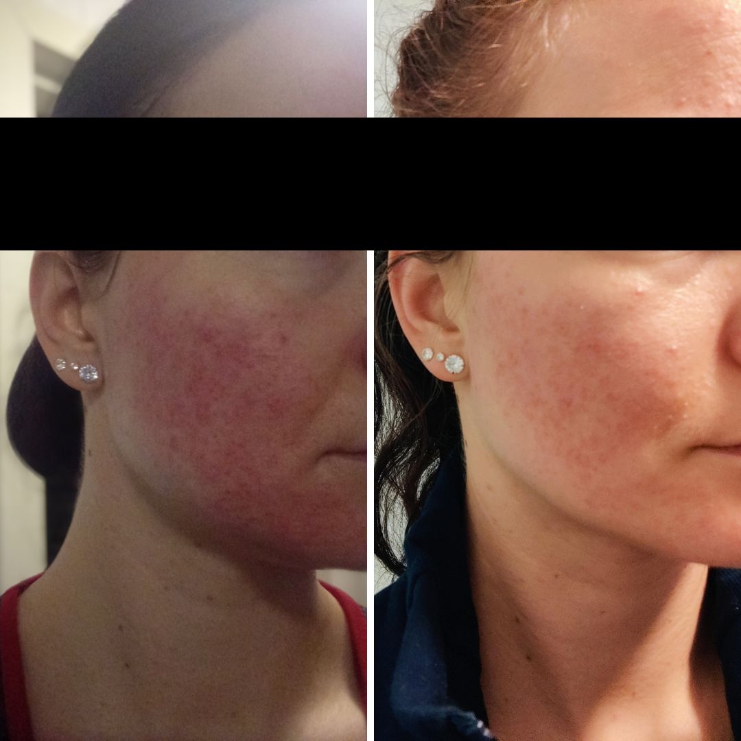 Ruusufinnin punoitus vähentynyt Saaren Taika tuotteilla