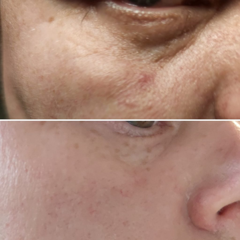 Kokemuksia Saaren Taika Ihon punoitusoireita rauhoittavasta hoitovoiteesta, joka sopii mm. rosacea iholle, ruusufinni iholle ja couperosa iholle sekä muihin ihon punoitusoireisiin.
