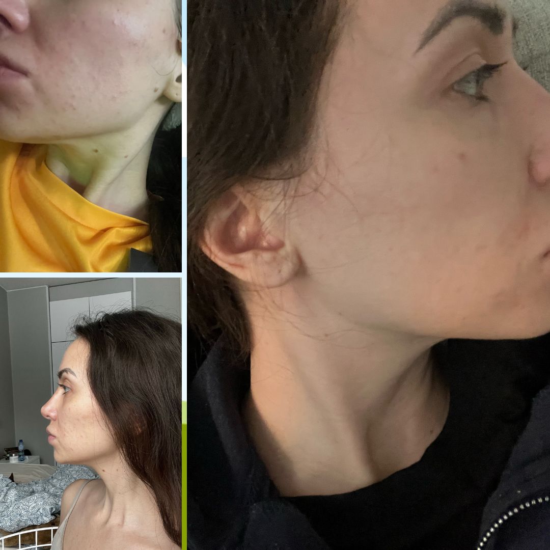 Hei, kiitos aivan mahtavista tuotteista. Ihoni on parantanut niin paljon siitä, kun maaliskuun lopussa aloin käyttää teepuusaippuaa. Nyt tilasin lisää tuotteita ja en malta odottaa muutoksia.