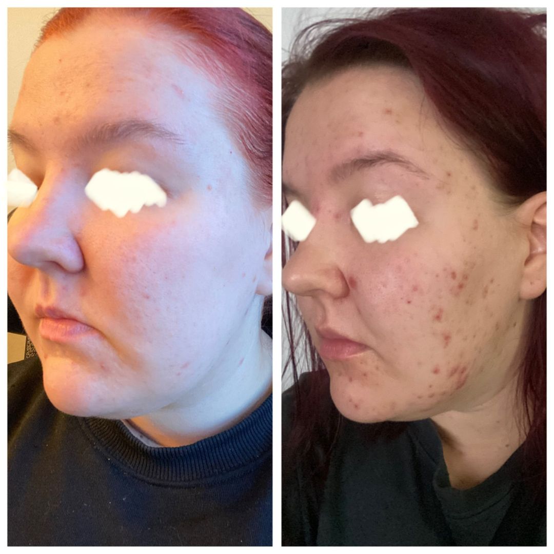 Suuri kiitos Nestemäiselle Teepuusaippuallenne! Ennen tätä tuotetta kokeiltuna on ollut ruokavalion muuttaminen, korealaisesta kosmetiikasta apteekki tuotteisiin kaikki mahdollinen, reseptilääkitys ja kosmetologi palvelut. Nimeä tuote niin olen varmasti testannut oli se sitten marketin halvin tai apteekin kallein! Olen pian kolmekymppinen ja elänyt tämän itsetuntoa syövän akne tuskan kanssa neljätoista vuotiaasta saakka. Kuvassa on 2kk tulos kun käytän vain Teepuusaippuaa aamuin illoin ja rasvana sheavoidetta. Nyt käyttänyt tätä tuotetta kohta vuoden ja edelleen iho yhtä hyvänä kuin kuvassa. Kiitos kiitos ja kiitos!