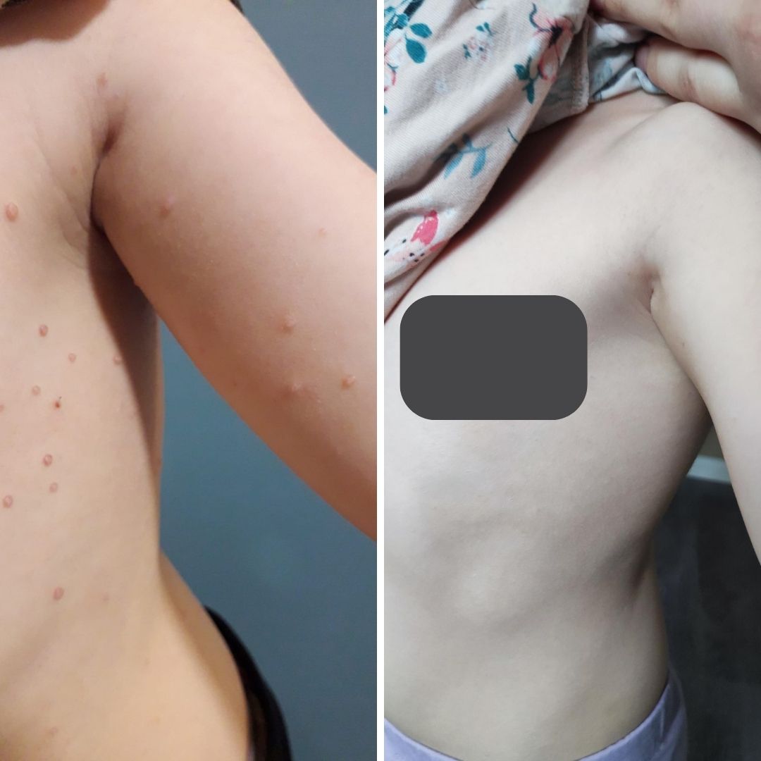 Pakko laittaa palautetta Saaren Taika Nestemäisessä Teepuusaippuasta. Ihan huippu tuote! Kolme vuotiaalla lapsella oli todella paljon ontelosyyliä. Apteekin tuotteet eivät tuoneet mitään apua ja lääkäri ei myöskään osannut neuvoa mitää hyvää hoito-ohjetta. Kokeilin ensimmäistä kertaa tilata Teepuusaippuaa ja parin viikon säännöllisellä käytöllä kaikki näpyt olivat poissa! Myös toisen lapsen atooppiseen ihoon tämä tuote on ollut todella hyvä! Suosittelen lämpimästi tuotteita! Liitteenä kuvia lapsen ihosta ennen ja jälkeen.