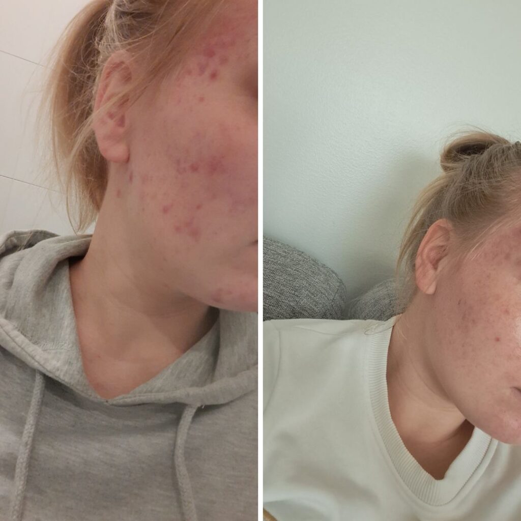 Moi! Olen koko nuoruus- ja aikuisiän kärsinyt akneihosta, varsinkin nuorena se vaikutti itsetuntoon todella paljon, kokeilin kaikki mahdolliset apteekin pesuaineet ja rasvat mutta en saanut niistä apua. Pari kuukautta takaperin sain äidiltäni testiin Saaren Taian Nestemäisen Teepuusaippuan ja pessimistinä ajattelin että tuskinpa siitäkään on apua, mutta kokeillaan. Yllätyksekseni huomasin kuitenkin pesuaineen todella auttavan! Tämä on ollut jokapäiväisessä käytössä, ihan huippu tuote!