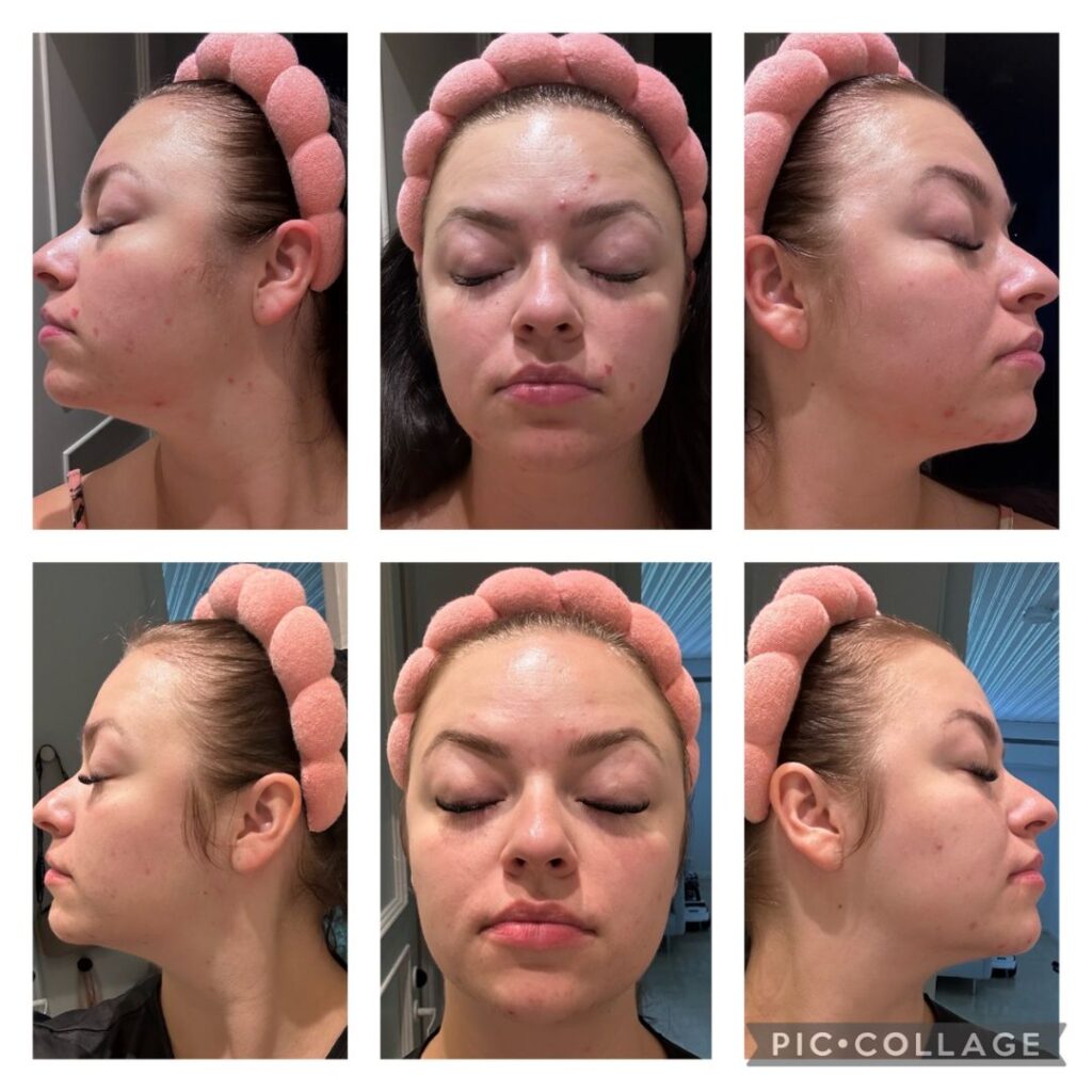 Heippa! Ensinnäkin niin ISO kiitos Saaren Taika tuotteista! Olen kärsinyt 3 vuotta hormoniaknesta lapseni syntymän jälkeen. Olen käynyt ihotautilääkärillä, syönyt eri antibiootteja ja käyttänyt erilaisia lääkärin määräämiä voiteita, mutta mikään ei ole auttanut. Iho on ollut aina myös todella kuiva vaikka mitä rasvaa laittaisi. Olen käyttänyt nyt tasan kuukauden nestemäistä teepuusaippuaa, ruusu-aloe kasvovettä, 24H kosteusvoidetta sekaiholle, salisyylihappo tehovoidetta näppyjä vastaan ja aktiivihiili & savi kasvonaamiota. Uusien finnien ja mustapäiden määrä on radikaalisti vähentynyt! Siinä missä ennen päivittäin valitin, että sattuu naamaan ihan vaan oleminen paikallaankin uusien syvien hormonifinnien vuoksi, niin nykyään kasvoihin tulee harvoin uusia epäpuhtauksia ja sellainen jos tuleekin, niin ne kuivuvat pois hetkessä eivätkä enää samalla tavalla kipeydy! Punoitus ja kuivuus on myös tyystin hävinnyt, iho on kuulas ja pehmeä! En malta odottaa mitä tuloksia saan pidemmällä aikavälillä! Kiitoskiitoskiitos! Tässä minun ennen ja jälkeen kuvat. Tällä hetkellä ei ole yhtään aktiivista finniä vaan vanhojen finnien arvet parantumassa ja vaalenemassa pikkuhiljaa.