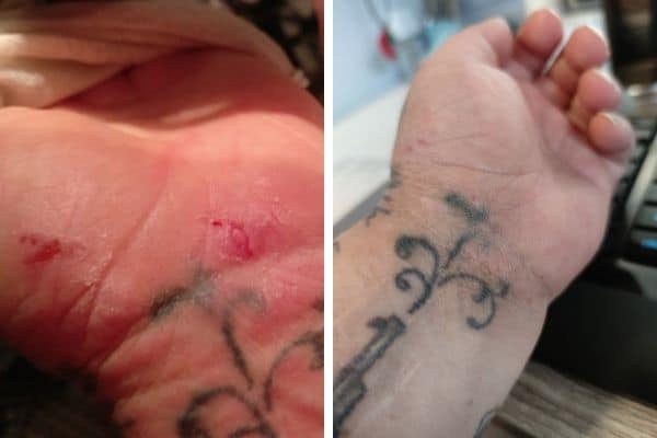 Käsi ihottuma ennen ja jälkeen