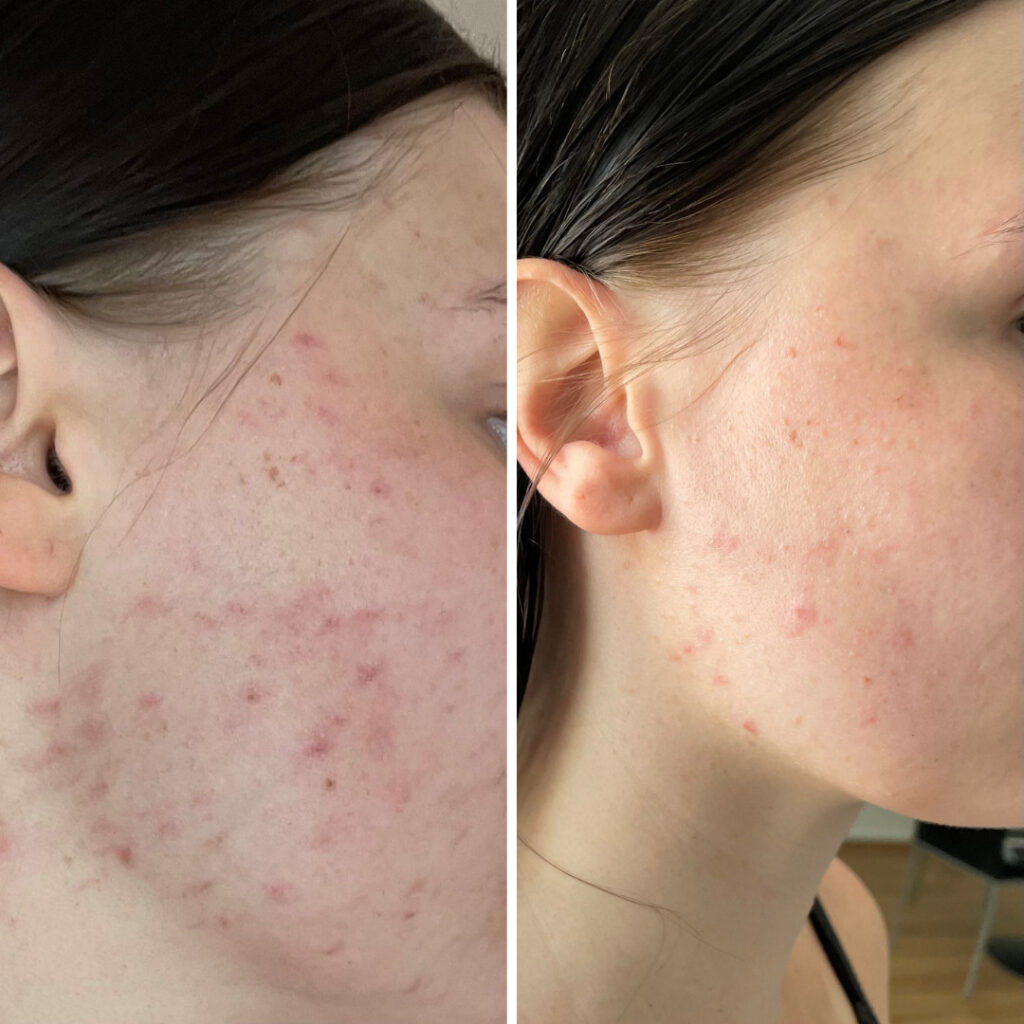 Olen taistellut jo tovin hormonaalisen aknen kanssa, johon kokeillut jos jonkunlaista tuotetta ja hoitoa, tuloksetta. Päädyin äitini lukemien suosituksien perusteella kokeilla Saaren Taika Teepuusaippuaa ja olen kyllä todella positiivisesti yllättynyt! Muutamassa kuukaudessa on tullut jo selvää parantumista kuten kuvista näkee. Täytyy myös sanoa, etten ole ainakaan itse kokenut ihon kuivuvan, vaikka netissä paljon lukeekin teepuuöljyn olevan kuivattavaa. Saaren Taika Teepuusaippuan lisäksi olen käyttänyt vain hajusteetonta kasvovoidetta.