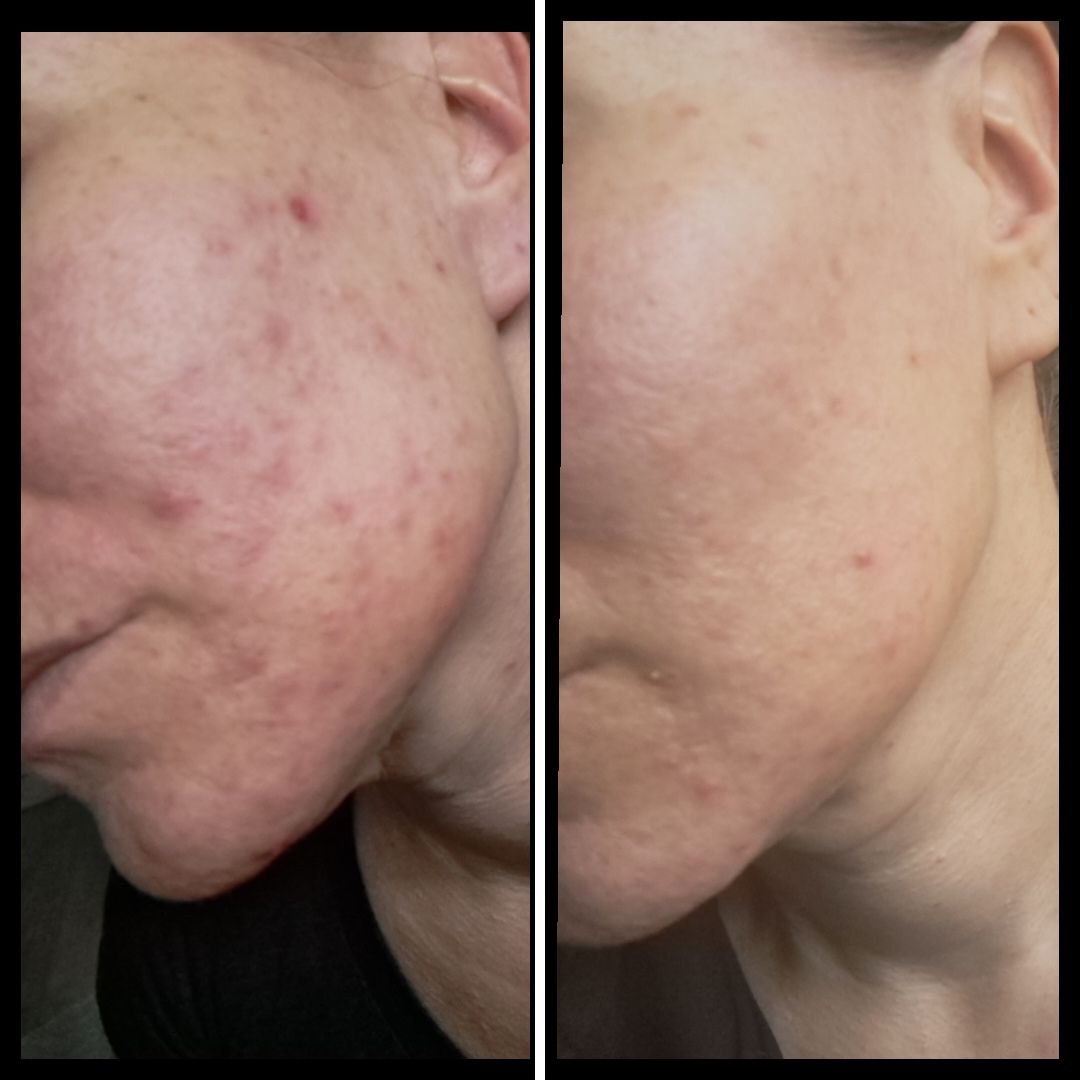 40+ akneiho räjähti loppukesästä täysin ja päädyin kokeilemaan tuotteitanne. Ostin ensimmäisenä käyttöön Saaren Taika Teepuusaippuan mutta koska epäilin pelkästään sen tehoa omalle iholleni, tilasin hetken päästä lisäavuksi myös Jojoba & Teepuu kasvoöljyn sekä 24h kosteusvoiteen sekaiholle. Myös Makadamiaöljy sheavoide on ollut satunnaisesti yövoiteena. Epäilin, päädynkö silti jälleen ihotautilääkärille, aiemmin on syöty mm. useita antibioottikuureja, myös isotretinoiini on tullut tutuksi. Iho kuitenkin on nyt n. kuukauden tuotteiden käytön jälkeen rauhoittunut ja osoittanut normalisoitumisen merkkejä. Jatkan taatusti tuotteiden käyttöä, ja vaikka iholla on akne, kaipaa se varsinkin talviaikaan kosteutta. Teidän tuotteilla on varmasti hyvä jatkaa ja katsoa, miten paljon käyttö vielä edistää ihon kuntoa.