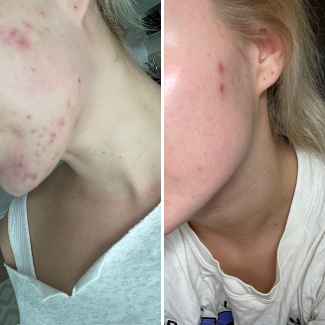 Hei, nyt on pakko tulla kiittämään teitä! Olen kärsinyt aikuisiän aknesta noin 3 vuotta. Ihotautilääkärillä käyty monesti, testattu vaikka ja mitä.. mistään ei ole ollut apua. NYT testasin teiltä kuuluisaa Saaren Taika Teepuusaippuaa..!! Ja tämä muutos on mahtava!!!! Olen käyttänyt teidän tuotteita vain vähän päälle kuukauden, KIITOS Ootte pelastanut mun iho-ongelman