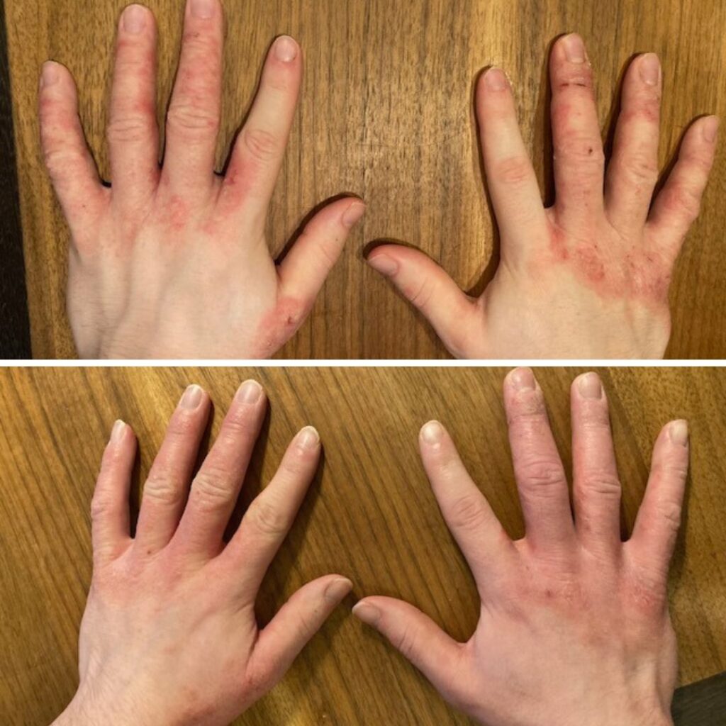 Hei! Super kiitokset Saaren Taika pala Teepuusaippuasta ja sen tuomasta avusta aikuisen poikani iho-ongelmaan. Kaikkea kokeilimme apteekkituotteista lähtien vaan sitten ajattelin, että jospa vielä tätä testaamme. Ja kyllä kannatti: eka kuvassa on lähtötilanne ja sitten kuva käsistä vajaan kahden viikon käytön jälkeen. Käsissä oli atooppista ihottumaa ja iho kutisee, hilseilee ja on haavoilla. Onhan sitä vielä hieman edelleenkin mutta tilanne on huomattavasti parempi ja mieli sen myötä helpottunut. Ja on hyvä jatkaa!!!