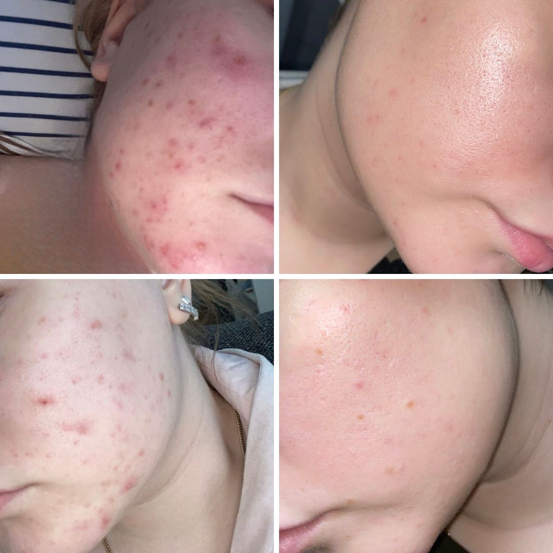 Moikka! Ajattelin pistää teille kuvia siitä kuinka hyvin teidän Saaren Taika Teepuusaippua on auttanut minua todella pahassa aknessa. Vuoden olen käyttänyt teidän Teepuusaippuaa, enkä vaihtaisi sitä kyllä enään mihinkään muuhun. Kaikkea apteekki tuotteista marketti tuotteisiin on tullut testattua, mutta tämä saippua pelasti naamani. Olen tässä ollut ihan ihmeissään, että miten tämä on mahdollista ja aloin jo uskoa, että aknesta en pääse ikinä eroon. Plussaa on myös, että teepuusaippua on todella riittoisaa ja kestää pitkään!