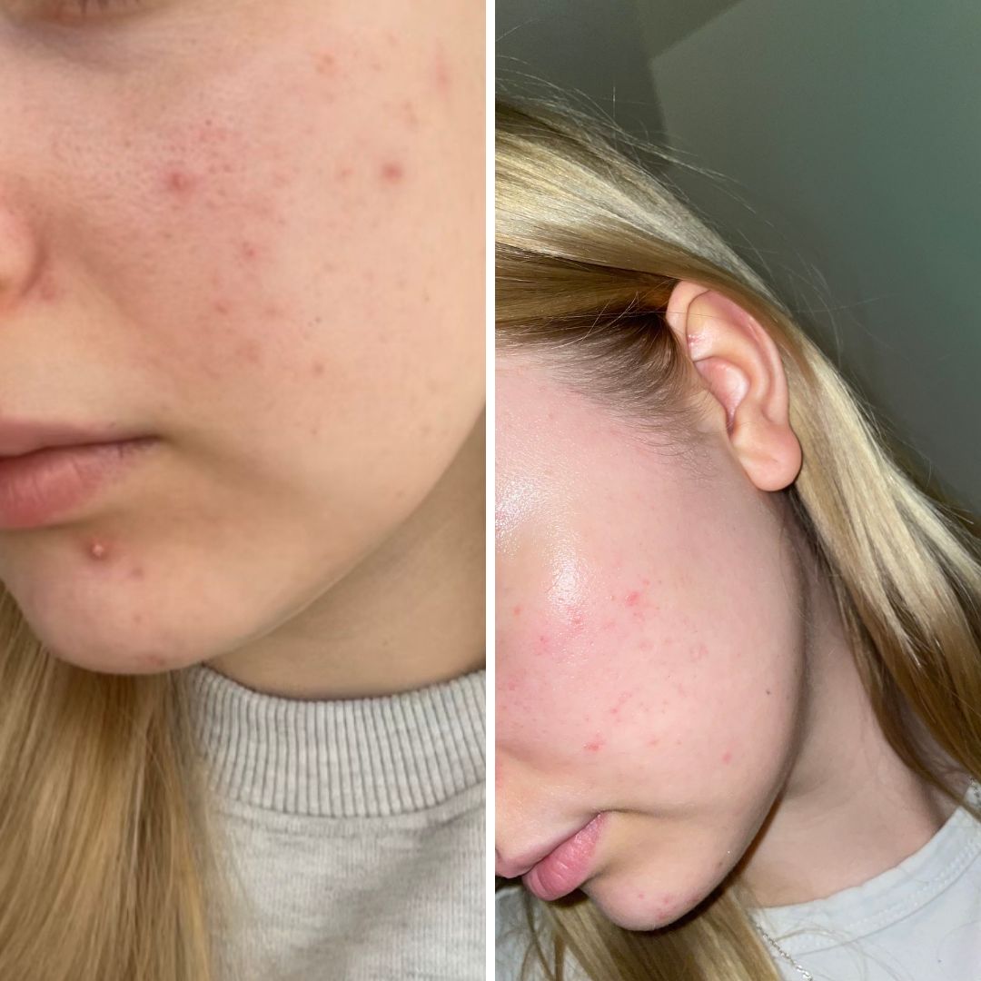 Hei, pakko kehua kun olen nyt kuukauden käyttänyt Saaren Taika Teepuusaippuaa akneen joka ei aikaisemmin helpottanut millään rasvalla tai seerumeilla mutta teepuusaippua kirkasti ihoa jo kuukaudessa ja uusia finnejä ei ole tullut