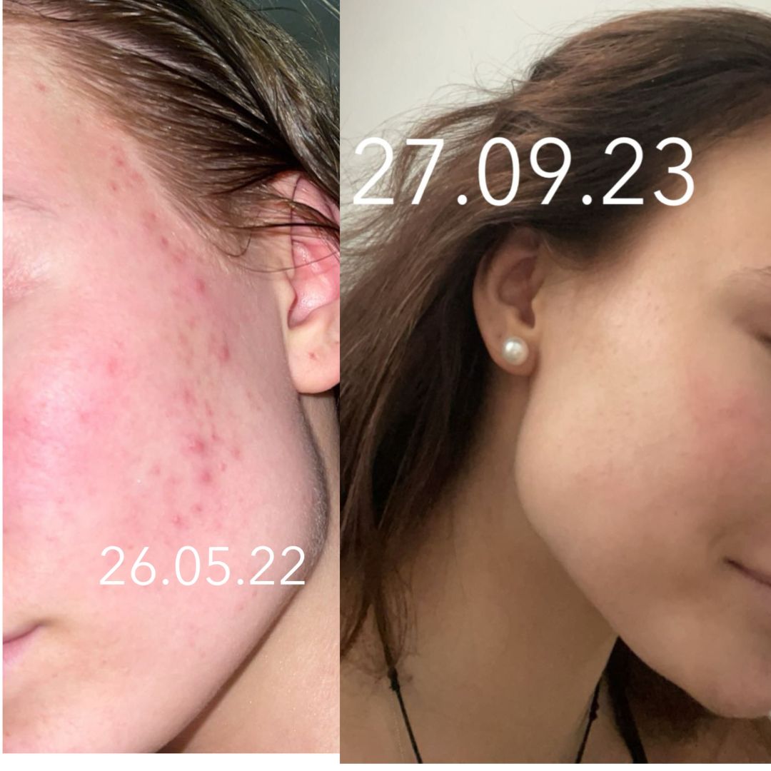 Moikka, Haluisin laittaa kommenttia Teepuusaippuasta. Mulla on alkanu akne teininä ja mikään ei ole auttanut ja antanut lopullisia ja pysyviä tuloksia. Teepuusaippua auttoi heti 2viikon sisään ja akne on pysynyt poissa eikä arpiakaan näy. Kiitos tästä itsevarmuusboostista!:)