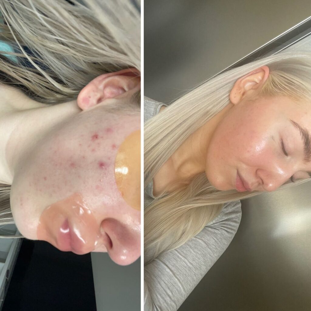 Saaren Taian teepuu palasaippuasta on ollut todella iso apu e-pillerien lopetuksen jälkeiseen hormonaalisen akneen ja epäpuhtauksien kurissa pitämisessä, päädyin tähän tuotteeseen sillä mikään ei enään auttanut edes ammattilaisten tekemät kasvohoidot tai tuotteet vaikka olen itsekkin kosmetologi, suosittelen ehdottomasti kokeilemaan jos muista tuotteista ei ole ollut apua! tämä tuote on jäänyt omaan kylppäriin jäädäkseen, olisimpa löytänyt tämän tuotteen aiemmin, iho paranee päivä päivältä!!😍🫶🏻