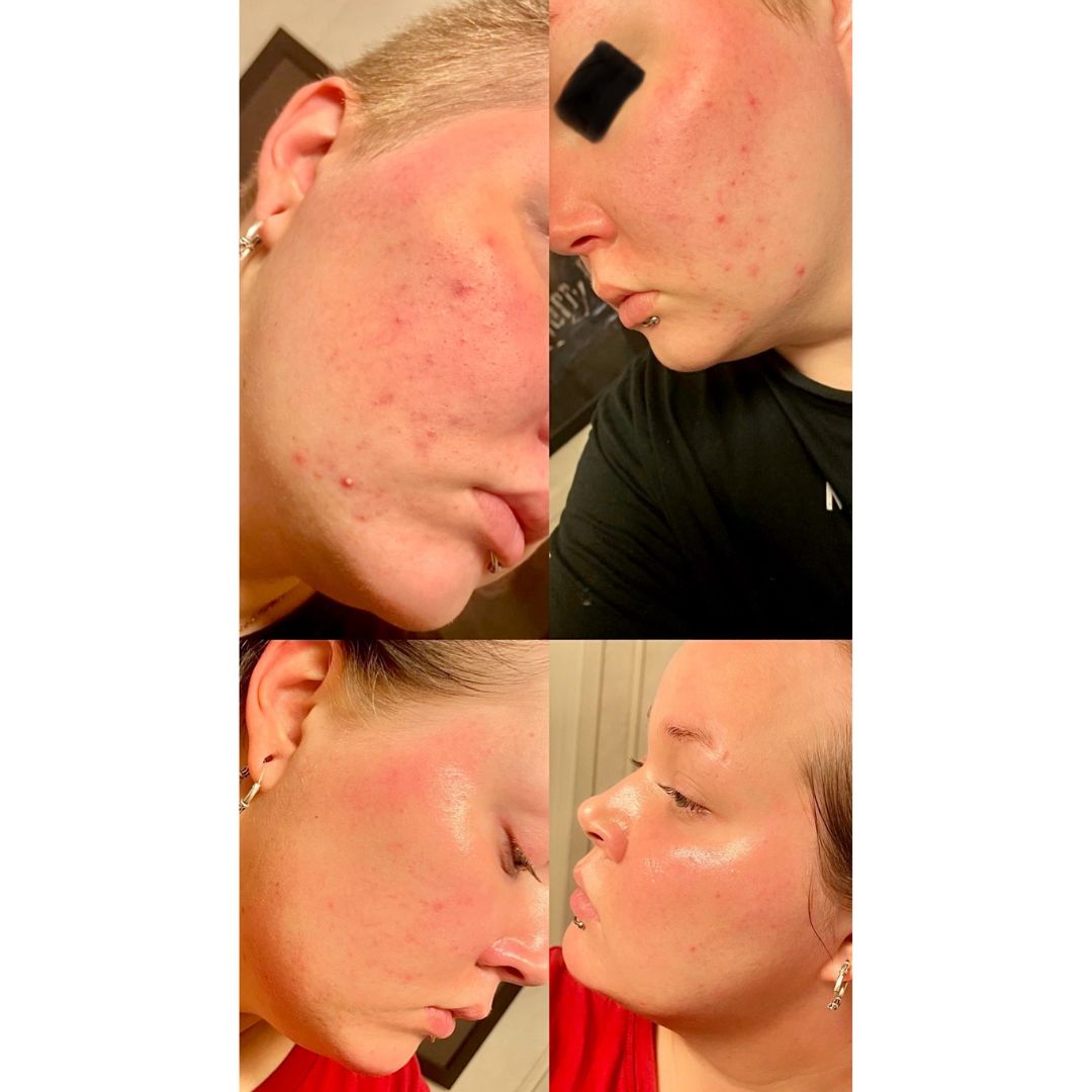 Moikka! Oon yrittänyt päästä aknen aiheuttamista kipeistä paiseista ja näppylöistä eroon jo yli 10 vuotta mutta tuloksetta. Kaikenmaailman rasvoihin ja muihin tökötteihin on tuona aikana kulunut varmasti tuhansia euroja. Lopulta törmäsin Saaren Taikaan! Muutamia aiheesta kertovia videoita katsellessani päätin kokeilla Teepuusaippuaa. Olin alkuun skeptinen koska kyse oli kuitenkin palasaippuasta joka normaalisti kuivattaa kasvoja, mutta positiiviseksi yllätykseksi tämä ei jättänyt edes kireyttä kasvoille! Reilun kahden kuukauden kuluttua käytöstä aloin huomaamaan miten punaiset ja kipeät paiseet ja näppylät alkoivat pikkuhiljaa häviämään eikä uusia enää tullutkaan! Kumpa olisin törmännyt Saaren Taikaan jo monta vuotta sitten!