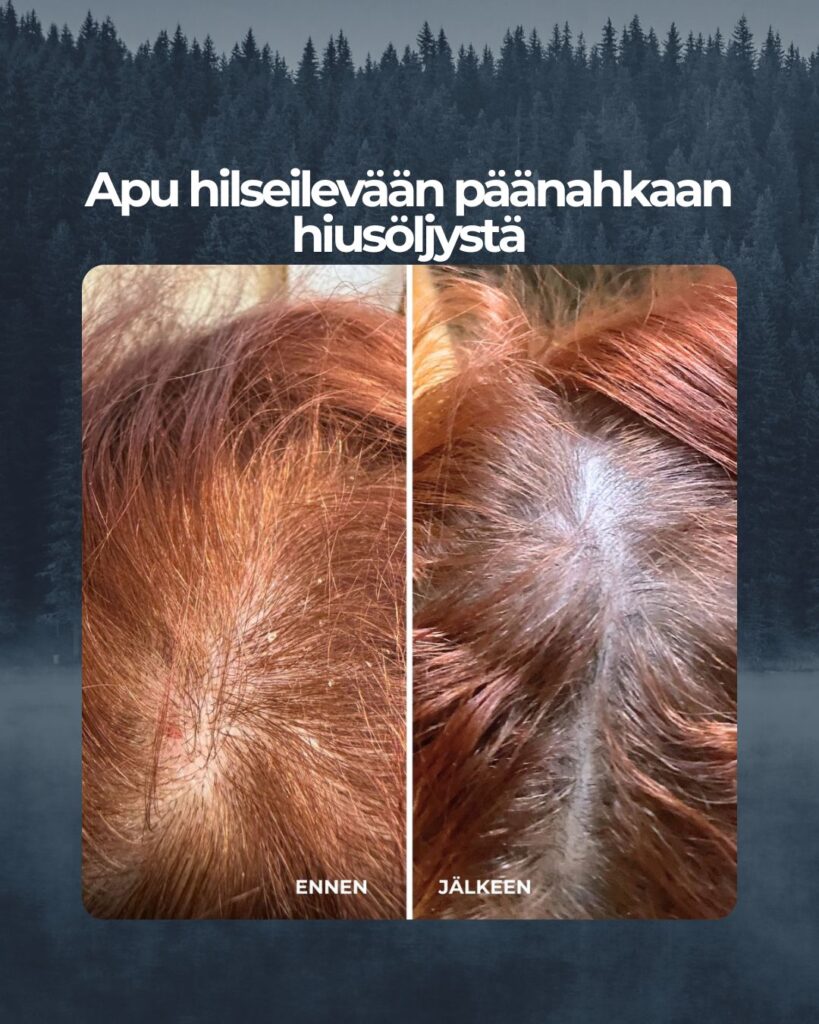 Kuvapalaute: Kokemus Argan Tyrni hiusöljystä Todella kuivat ja katkeilevat hiukset ja hilseilevä päänahka joka menee verille asti.