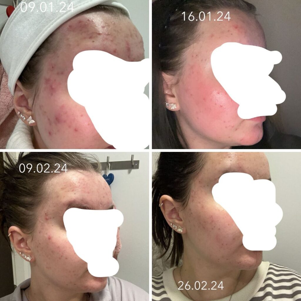 Tilasin teiltä hormonaalisen aknen ihonhoitosetin, missä oli teepuusaippua, spot control tehovoide ja kasvonaamio aktiivihiili ja savi!! Olen niin tyytyväinen että haluan että muut näkee mihin tuloksiin näillä tuotteilla pääsee!! Alotin siis 9.1.2024. ja nyt on kulunu melkein 2kk ja tässä tulokset. Oon ihan super tyytyväinen ja kasvot näyttääkin niin hassulta ku en oo näin puhdasta pitkää aikaa nähny! Vähän vielä näppyjä iholla mutta kun katsoo alotuspäivän kuvaa ni eihän noi nykypäivän näpyt ole enää mitään! Kiitos teille kun sain itsevarmuuden olla ilman meikkiä!