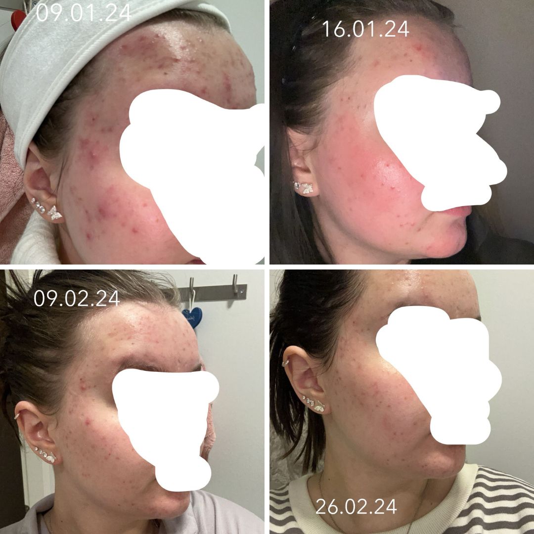 Tilasin teiltä hormonaalisen aknen ihonhoitosetin, missä oli teepuusaippua, spot control tehovoide ja kasvonaamio aktiivihiili ja savi!! Olen niin tyytyväinen että haluan että muut näkee mihin tuloksiin näillä tuotteilla pääsee!! Alotin siis 9.1.2024. ja nyt on kulunu melkein 2kk ja tässä tulokset. Oon ihan super tyytyväinen ja kasvot näyttääkin niin hassulta ku en oo näin puhdasta pitkää aikaa nähny! Vähän vielä näppyjä iholla mutta kun katsoo alotuspäivän kuvaa ni eihän noi nykypäivän näpyt ole enää mitään! Kiitos teille kun sain itsevarmuuden olla ilman meikkiä!