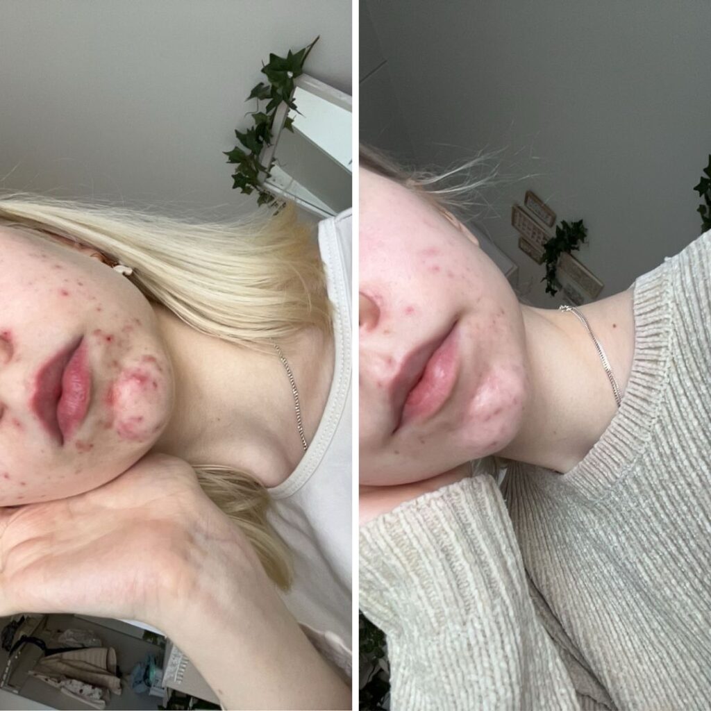 Aloitin teepuusaippuan käytön hormonaaliseen akneen lokakuussa, parissa kuukaudessa alkoi näkyä muutoksia ihossa! Enää jäljellä vain arpia aknesta. Oma iho on aina vaikuttanut itsetuntoon ja välillä on itkettänyt nähdä iho niin huonossa kunnossa, teidän tuotteet on ollut niin ihana pelastus. Nykyään käytän Teepuusaippuan sivussa myös Aktiivihiili Teepuusaippuaa. Tämä kombo on osoittautunut parhaaksi. Odotan innolla, miten ihoni kunto paranee vielä tästäkin paremmaksi!