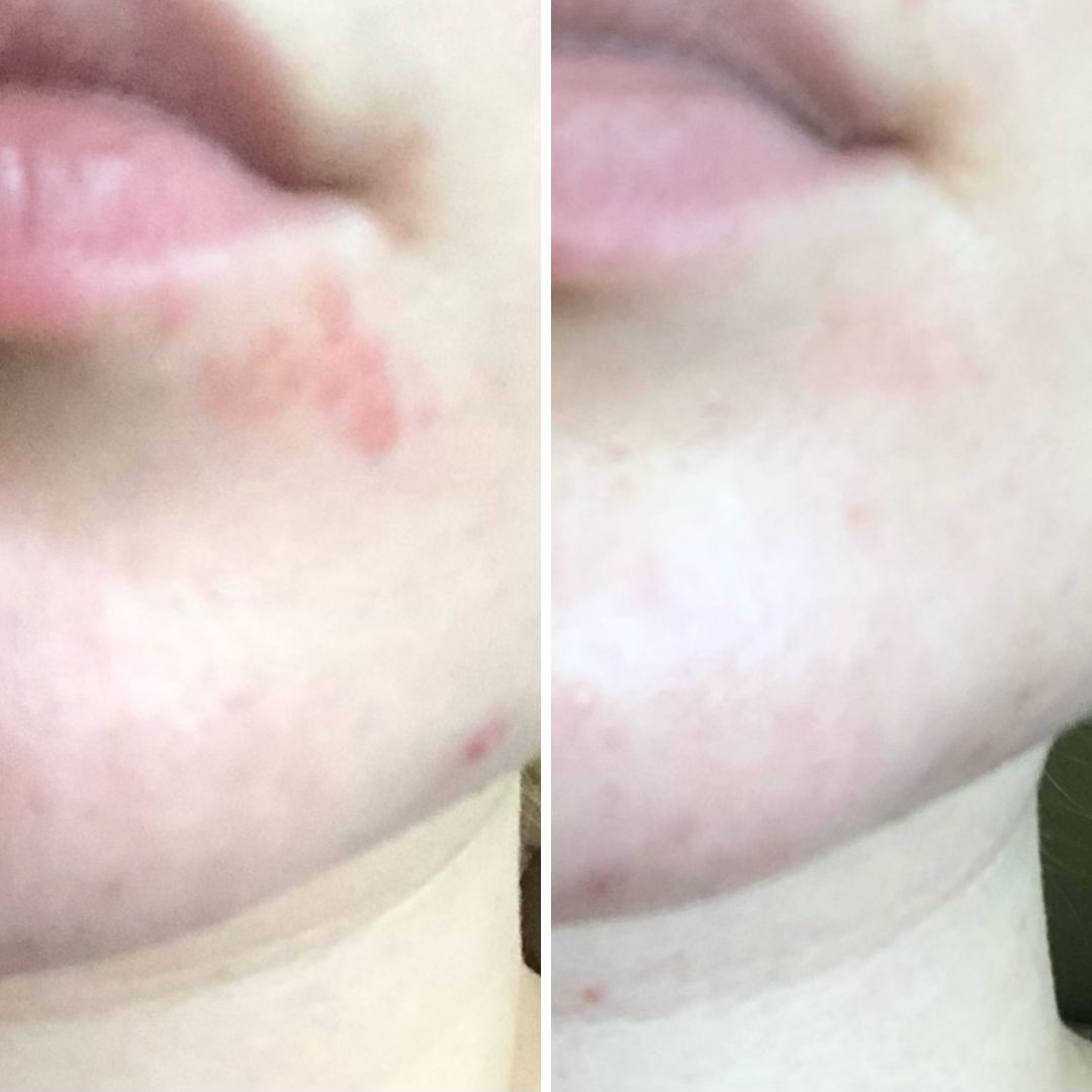 Aknen hoitoa Saaren Taika teepuusaippualla