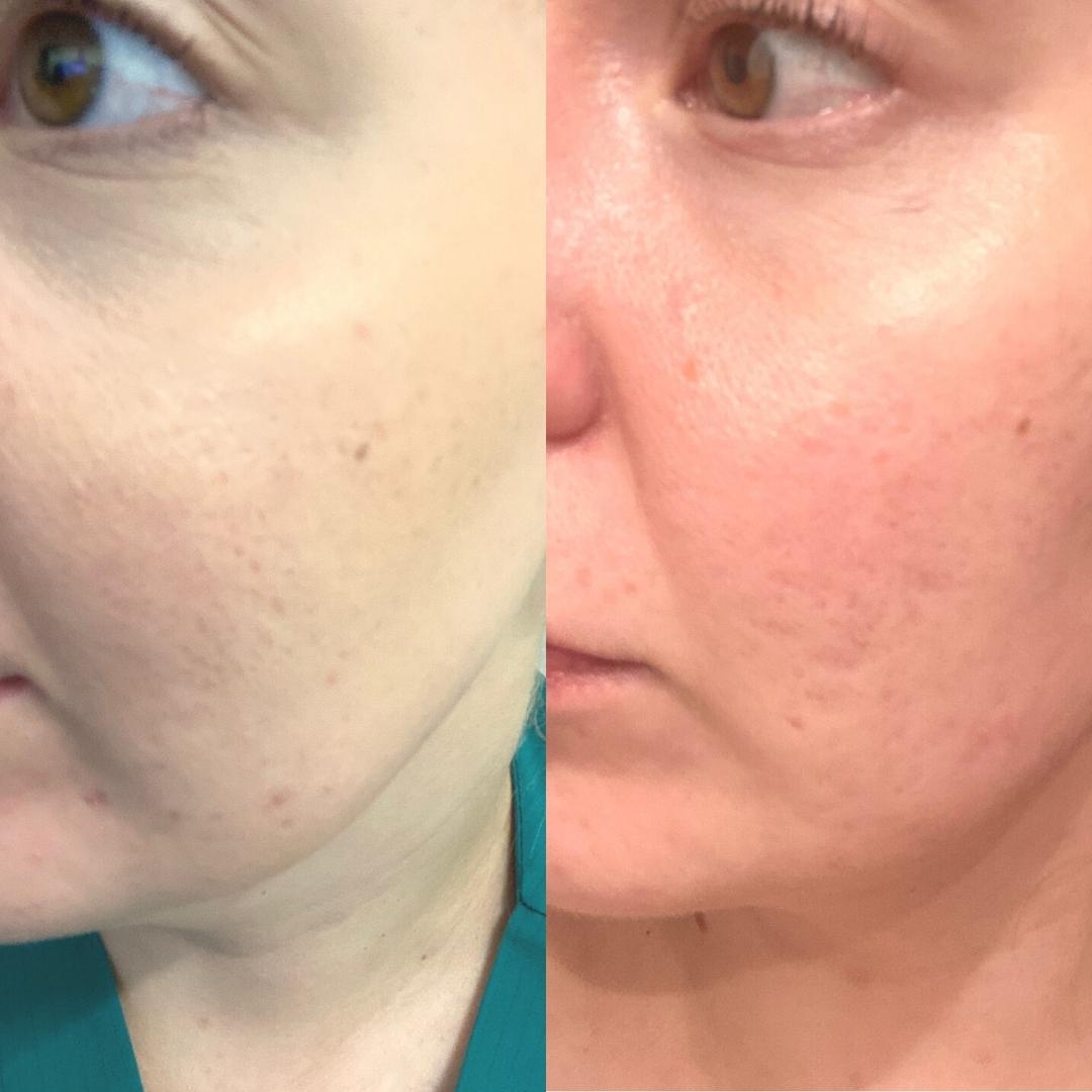 Tässäpä kuvat Spot Control voiteesta. Vasemmalla jälkeen ja oikealla ennen. Kuvien välissä useampi kk. Punoitus selvästi hävinnyt ja näpyt tasoittuneet.