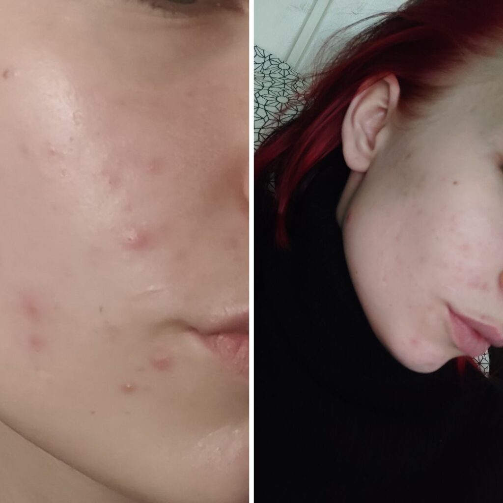 Hei. Olen ollut kyllä super tyytyväinen teidän tuotteisiin. Käytössä ollut 24h kosteusvoide sekaiholle, Spot control tehovoide, Aktiivihiili Teepuusaippua ja Aktiivihiili konjacsieni Apu on näkynyt jo viikon käytön jälkeen🤩