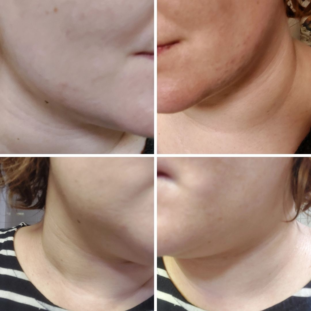 Olen jo vuosia kärsinnyt näpyistä ja epätasaisesta ihosta nuorella iällä. Aikuisiällä ne häipyivät mutta muutama vuosi sitten ne ilmestyivät taas. Olen maksanut malttaita hinnakkaista kasvojenhoidoista, kokeillut jos mimmoisia aineita, tehnyt ruokavalio muutoksia, peittänyt näppyjä meikeillä, tuloksetta. Eksyin teidän sivustolle ja päätin tilata teiltä muutamia tuotteita. Mukaan tarttui Spot Control tehovoide näpyille. Jo vuosien ajan pettyneenä olin hyvin skeptinen aluksi, koska mitkään muutkaan tuotteet eivät ole tehonneet. En voi kylliksi sanoa, kun sanon että KIITOS TUHANNESTI! Vasta viikon verran olen käyttänyt tuotetta ja ne vuosien näppylät ovat hävinneet. Ette uskokkaan miltä tuntuu kun voi tuntea itsensä jälleen kauniiksi kun kasvojen iho on sileä kuin vauvan peppu ja epätasaisuudet ovat hävinneet! Kiitos että myytte kyseistä tuotetta, toivon sydämestäni että ette ikinä lopeta tämän tuotteen myymistä. Vuosien etsintä vihdoin palkitaan ja löysin tuotteeni, aine on lisäksi niin riittoista että tuntuu että ainetta ei häviä ollenkaan purkista, mistä valtavan iso plussa.. Kaksi ensimmäistä kuvaa on näpyistä, kaksi viimeistä kuvaa ovat viikon Spot Control tehovoiteen käytön jälkeen. KIITOS, SAAREN TAIKA 💕