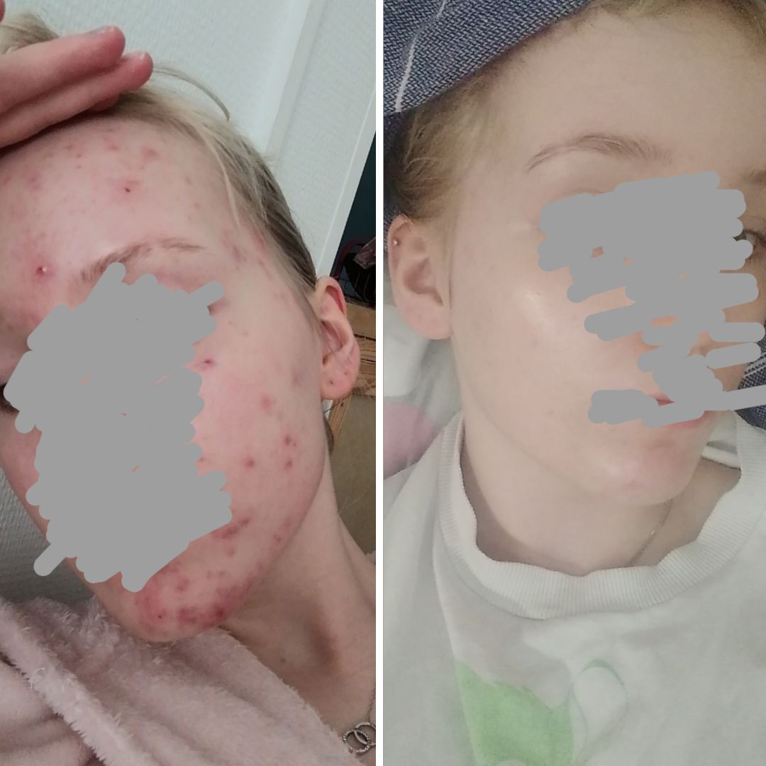 Kaksi kuvaa naamastani, välissä on noin puolisen vuotta.. Nyt puolen vuoden aikana käytössäni on olleet päivittäin teepuusaippua, spot control sekä salisyylihappo tehovoiteet näpyille. Ainoat tuotteet, jotka ovat oikeasti toimineet tähän mennessä akneiholleni.. Ei voi sanoa muutakuin iso Kiitos!