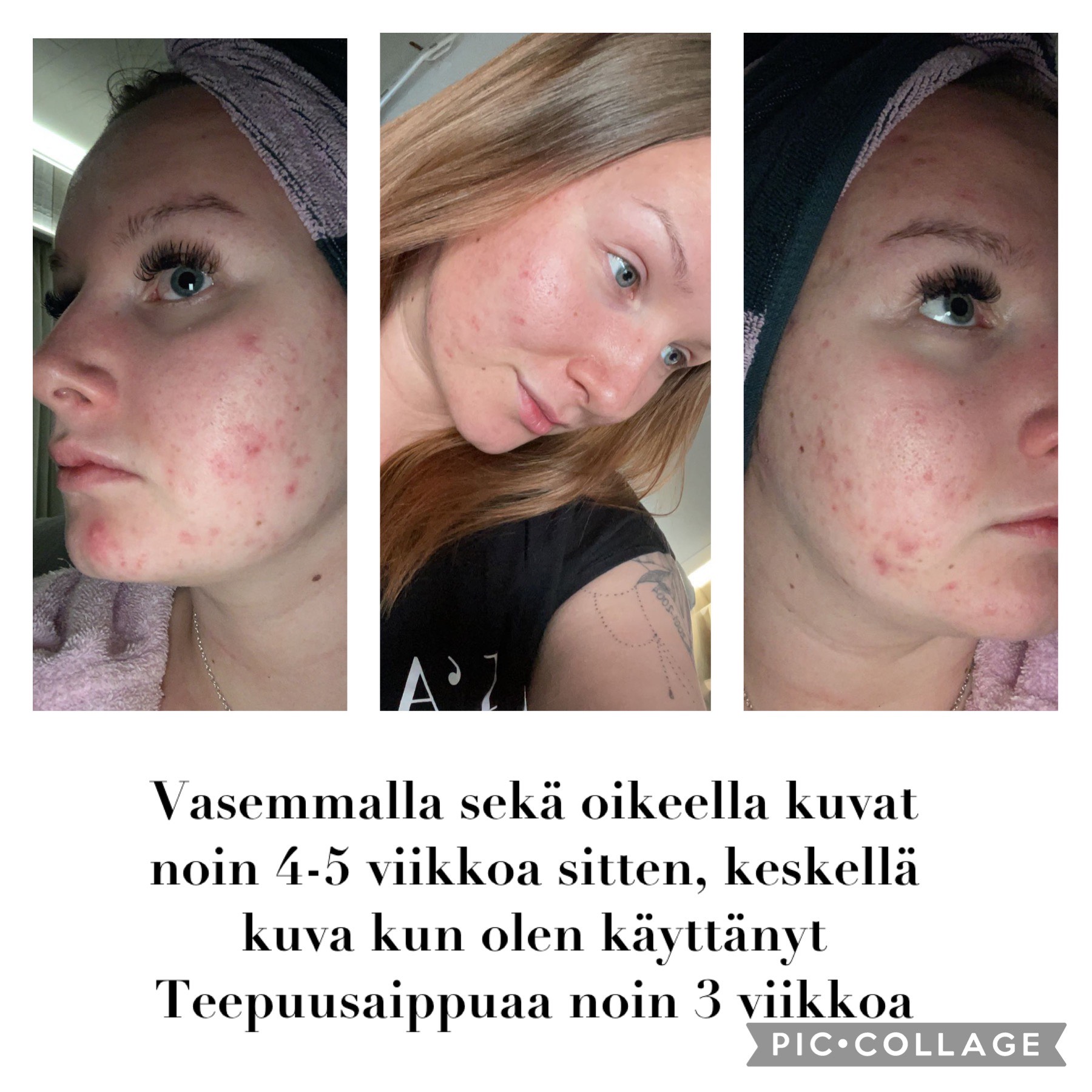 Ennen ja jälkeen kuvia akneihosta, joka on tullut huomattavasti paremmaksi Saaren taika Teepuusaippuan avulla