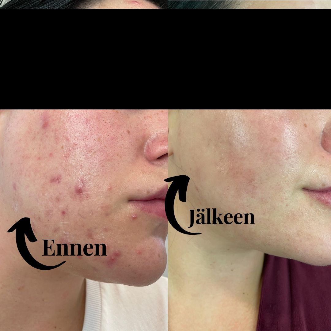 Viime joulukuussa ystäväni, jolla on hyvin samankaltainen iho, antoi minun testata omaa Saaren Taika Spot Control tehovoidettaan. Laitoin sitä illalla yhden näpyn päälle ja aamulla se oli poissa. Olin vaan, että wow, onpa hyvää tavaraa! Tästä innostuneena hankin itsellenikin samaa voidetta ja lisäksi Saaren Taika teepuusaippuaa. Vähän aikaa sitten otin käyttöön myös Aktiivihiili & Savi kasvonaamion. Nyt kun olen löytänyt nämä tuotteet, en aio enää hankkia muita. Teepuusaippua jättää iholle ihanan puhtaan pinnan, mutta ei kuivata ihoa. Siitä on tullut ehdoton lemppari sekä nestemäisenä, että palasaippuana, enkä voisi kuvitella olevani ilman sitä. Saippua lähtee aina mukaan esimerkiksi yökyläilyille. Spot Control sen sijaan on todella hyvä täsmähoito epäpuhtauksille, itse käytän sitä esimerkiksi leuan alueelle. Naamio jättää ihohuokoset putipuhtaiksi ja tuo kasvoille todella freesin olon. Kombona nämä tuotteet ovat ratkaisseet hyvin ihohaasteitani.