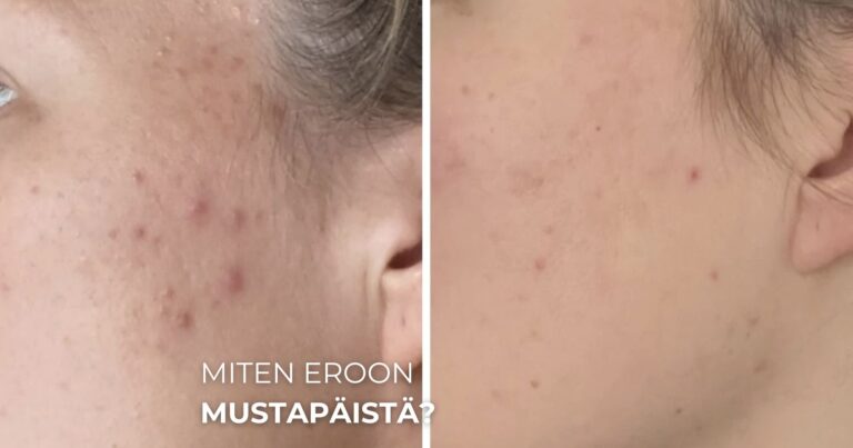 Miten eroon mustapäistä?