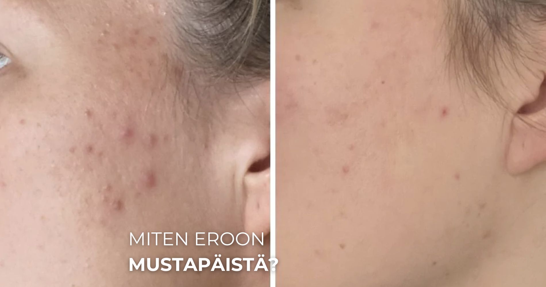 Miten eroon mustapäistä?