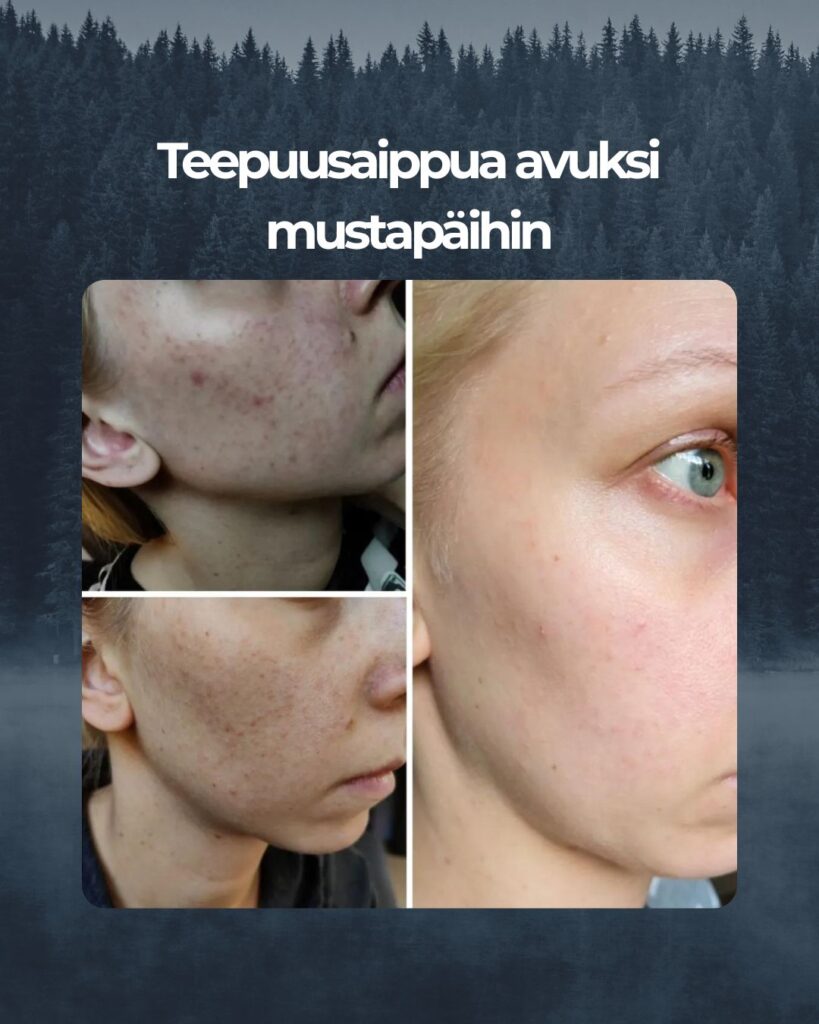 Kuvapalaute: Hei! Ajattelin kiittää teitä tästä ihanasta tuotteesta joka toi avun omaan iho ongelmaani. Kasvojeni Iho "räjähti" kun aloitin työt äitiysloman jälkeen uudessa työssä. Kokeilin monia kaupan ja apteekin tuotteita mutta tuntui, että mikään ei auttanut tai saattoi auttaa vähäksi aikaa kunnes ihoni meni jälleen huonoon kuntoon. Taisin törmätä ensi kertaa kyseiseen tuotteeseen netissä ja pitkän harkinnan ja tutkimisen jälkeen raaskin ostaa pala teepuusaippuan. Kuukausi käytön jälkeen ihoni oli parantunut huomattavasti ja nyt vuoden käytön jälkeen ihoni kunto on pysynyt todella hyvä vaikka en joka päivä saippuaa käytäkkään. Aika ajoin on vain pieniä näppyjä siellä täällä mutta mitään "räjähdystä" ei ole tullut! Kiitos teille oloni on itsevarmempi taas 😍