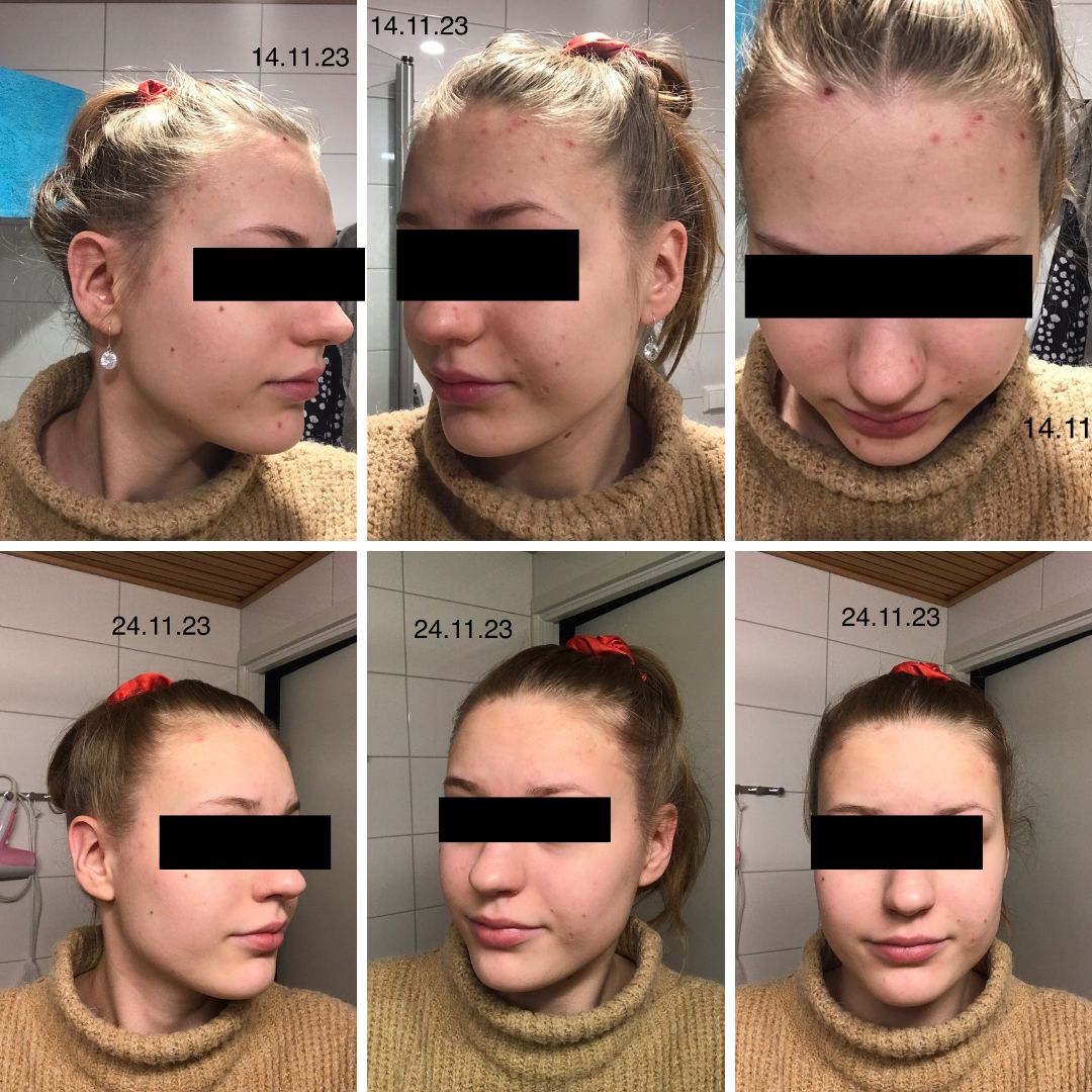 Moikka! Tilasin teiltä Hyaluronihappo & Vitamiinit ACE kosteuttajan ja Aktiivihiili-naamion hoitaakseni kuivaa ihoa ja minipillereitä johtuvia finnejä ja muita epäpuhtauksia ja olen kokenut että nämä tuotteet on todellakin auttanut ja yllätyin kuinka tosi nopeasti tuli muutosta. Mulle vaan jäänyt ruvet kun ollu pahatapa repiä pahimpia finnejä mutta nyt ei oo ollut sitäkään kun kaikki näpyt ovat poissa.