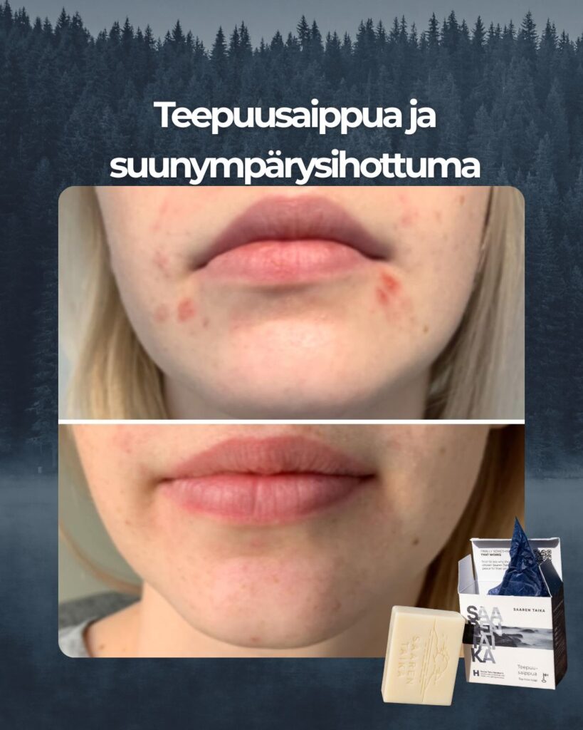 Kuvapalaute: Ajattelin, että kun itsekin eksyin teidän sivustolle ihoni ollessa huonossa kunnossa ja näin ennen ja jälkeen -kuvat, niin haluaisin jakaa myös omat kuvani teepuusaippuasta. Tilasin teepuupalasaippuan, sillä olin lukenut siitä erinomaisia kokemuksia ja sain suualueen iho-ongelmiini valtavan avun! Kiitos siitä teille! Ennen ja jälkeen -kuvieni välissä on pari kuukautta aktiivista teepuusaippuan käyttöä ja ihoni voi nyt paljon paremmin! Aion ehdottomasti jatkaa teepuusaippuan käyttöä jatkossakin!