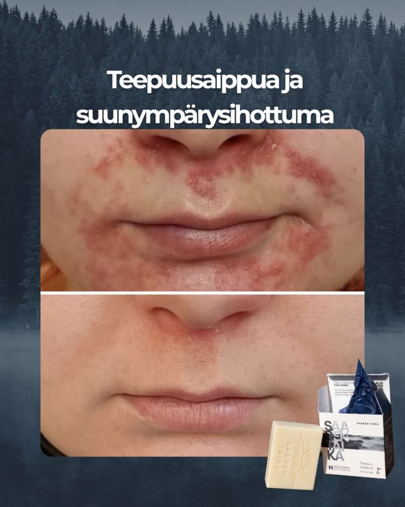 Kuvapalaute: Hei! Olen kärsinyt suunympärysihottumasta n.7 vuotta. Aika ajoin jokin aiheuttaa tulehduksen ja naama hohtaa punaisena. Kuulin teidän teepuusaippuasta kaverilta ja päätin kokeilla. Ensin saippua ei tuntunut auttavan, mutta kun jaksoin jatkaa käyttöä, tulehdus hellitti ja pikkuhiljaa paraneminen alkoi. Empä taida uskaltaa olla käyttämättä enään! Tässä ennen ja jälkeen kuvat: Ennen 3.7. ja jälkeen 20.8.