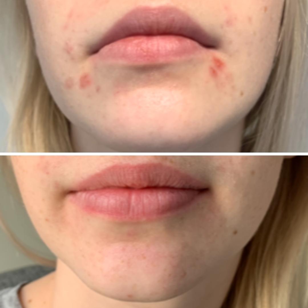 Ajattelin, että kun itsekin eksyin teidän sivustolle ihoni ollessa huonossa kunnossa ja näin ennen ja jälkeen -kuvat, niin haluaisin jakaa myös omat kuvani teepuusaippuasta. Tilasin teepuupalasaippuan, sillä olin lukenut siitä erinomaisia kokemuksia ja sain suualueen iho-ongelmiini valtavan avun! Kiitos siitä teille! Ennen ja jälkeen -kuvieni välissä on pari kuukautta aktiivista teepuusaippuan käyttöä ja ihoni voi nyt paljon paremmin! Aion ehdottomasti jatkaa teepuusaippuan käyttöä jatkossakin!