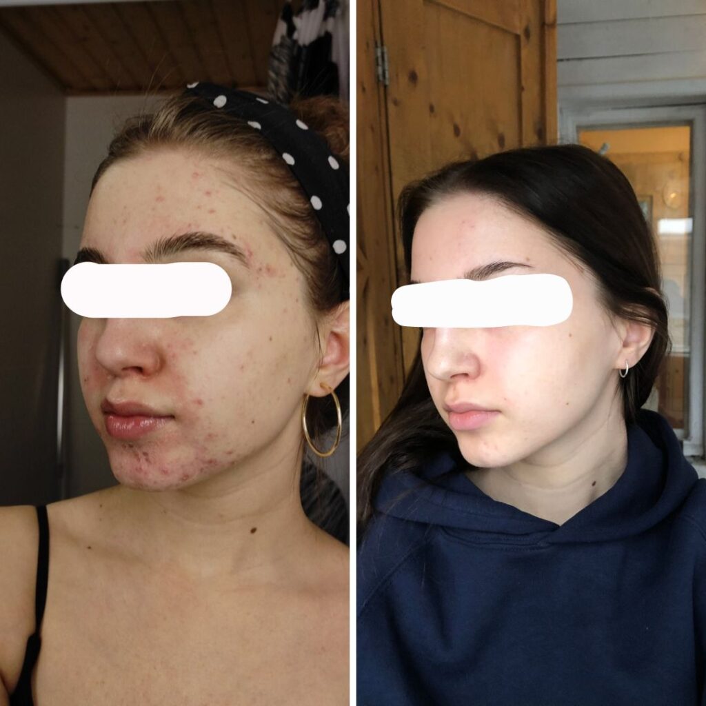 Moikka! Huomasin instagramistanne, että teille saa lähettää tuotekokemuksia ja ennen ja jälkeen kuvia. Aloitin Saaren Taika Aktiivihiili teepuusaippuan käytön tammikuussa 2023. Olin kokeillut kaikki mahdolliset apteekin rasvat ja käynyt lääkärillä ihoni takia. Saippuasta oli heti apua aivan mielettömästi ihooni ja sopi todella hyvin herkälle akneiholleni. Saippua on ollut pelastus akneiholleni ja olen käyttänyt sitä päivittäin jo yli puoli vuotta. Aivan huipputuote, kiitos! Alla vielä ennen jälkeen kuvat uudelleen. Eli kuvien välillä noin 7 kuukautta.