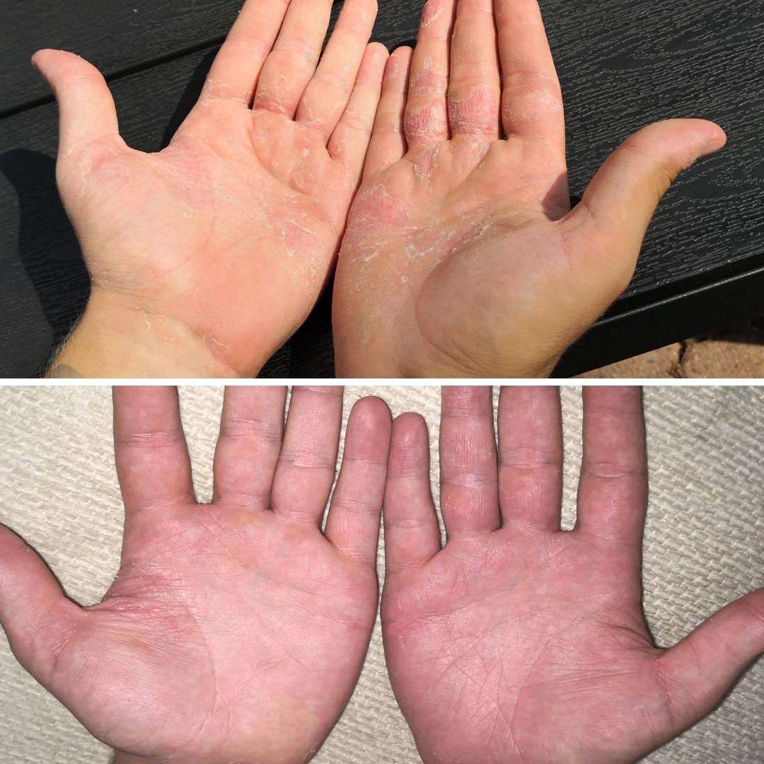 käsi-ihottuma parani Kamomilla Sheavoiteella ennen ja jälkeen kuvat