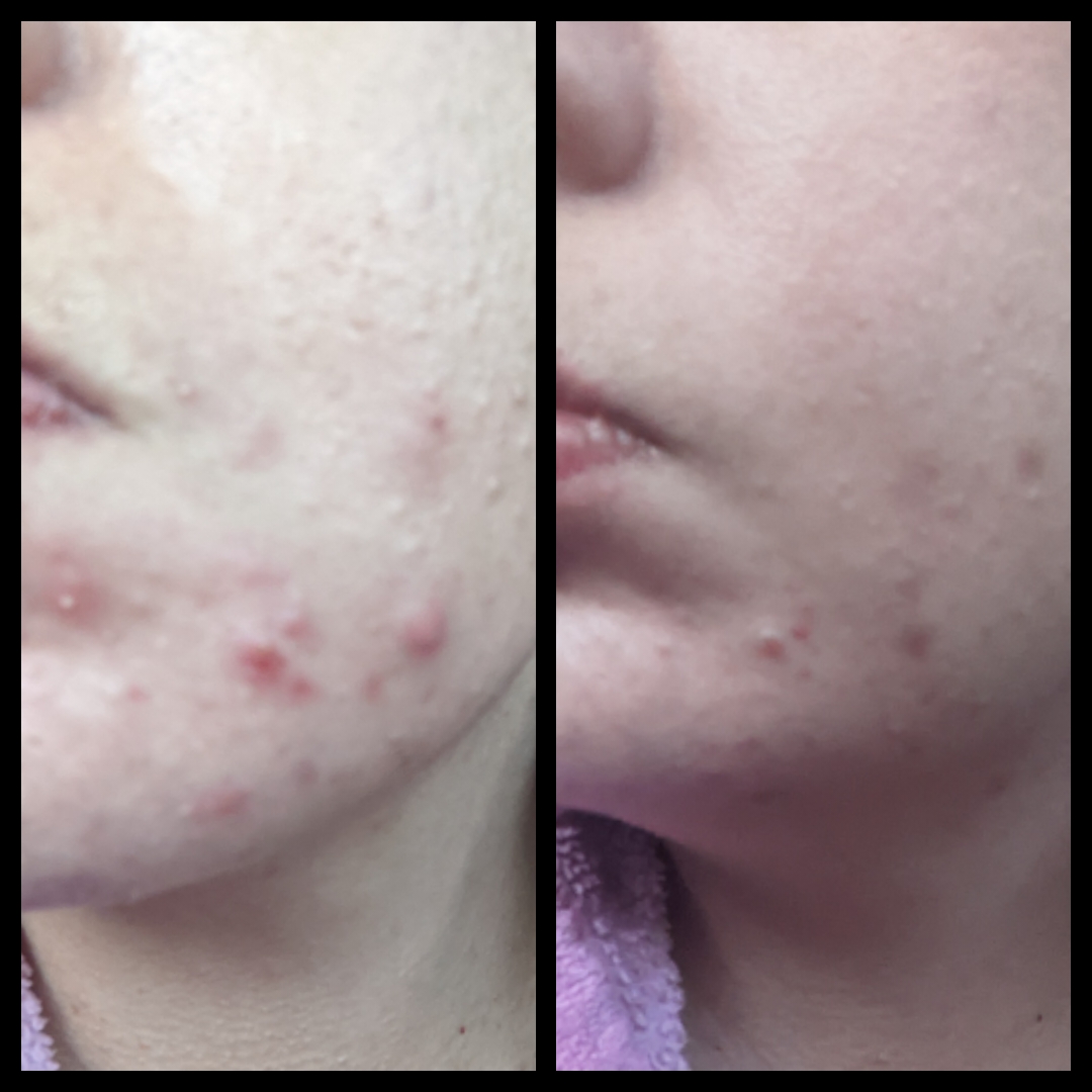 39-vuotiaan öljyinen iho ja kivulias akne sai helpotusta aktiivihiili teepuusaippuasta, ruusu aloe kasvovedestä, aktiivihiili&savi kasvonaamiosta ja spot control voiteesta! Kuva kertokoon mitä vaikutuksia tuotteilla sai aikaan jo kolmessa viikossa!