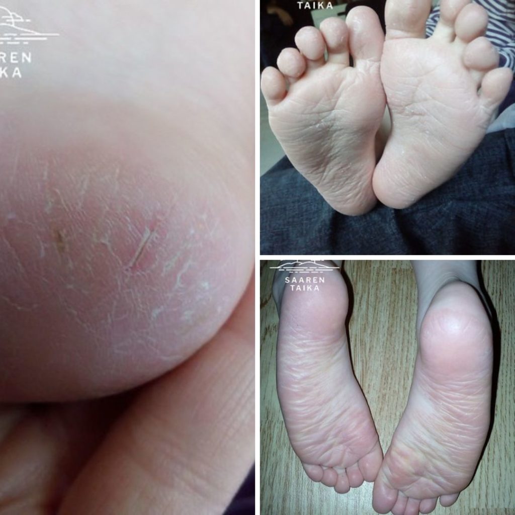 Kuivat ja halkeilevat jalkapohjat sileiksi Saaren Taika Kamomilla sheavoiteella