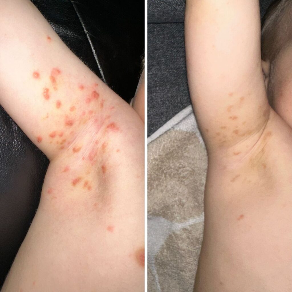 "Moikka. Siis pakko kehua Saaren Taika Teepuusaippua. Tällä lapsella ollut todella pahat molluskat kainaloissa. Löysin sitten teidät ja ehkä meidän pelastus, 3 viikkoa joka ilta pesty teepuusaippualla ja lopputulos on WOW. Tässä kuvat ennen ja jälkeen. Ei varmaan tarvitse mainita mikä on ennen ja mikä jälkeen."
