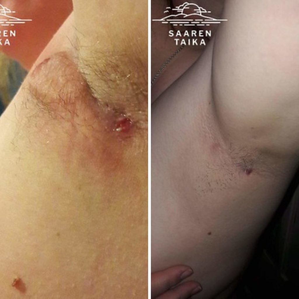 Minulla on hidradenitis suppurativa, Eli krooninen sairaus joka aiheuttaa tulehduksia ihohuokosiin ja hikirauhasiin. Tulehdus aiheuttaa märkiviä paiseita ja on erittäin kivulias. Näitä voi esiintyä kainaloissa, nivusissa, rintojen alla. Yleensä kuitenkin hiostavissa paikoissa. Tulehdukset tulevat ja menevät. Tauti ei ole kovin tunnettu/yleinen, mutta suomessakin niitä on kuitenkin monella. Minulla on ollut suurimpana ongelmana lähinnä kainalot. Aloin käyttämään teidän teepuusaippuaa ja kahden kuukauden käytön jälkeen tulehdukset rauhoittuivat ja on nyt pysynyt rauhallisessa tilassa noin neljä kuukautta. Olen käyttänyt myös muita teidän palasaippuoita. Pystyn käyttämään myös teidän Appelsiini voidedeodoranttia sen ärsyttämättä kainaloitani. Koen teidän tuotteiden auttaneen elämääni ja aion jatkaa niiden käyttöä myös tulevaisuudessa.” Kuvat tulehduksesta ja nykyistä tilasta kainalossa.
