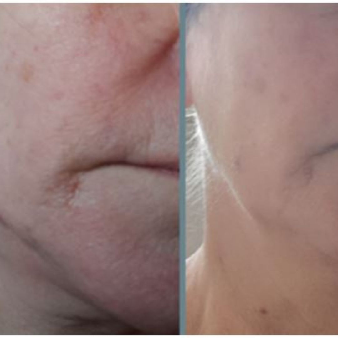 Ihoni on kuiva, ikääntyvä ja punoittaa poskien ja leuan kohdalta. Kokeilin aluksi erästä toista Saaren Taika kasvovoidetta, mutta se ei ollut minun iholleni hyvä. Onneksi en antanut periksi ja tutustuin tarkemmin Saaren Taika tuotteisiin ja nyt 2 kuukauden käytön jälkeen voin suositella tätä tuotetta muillekin ja kasvovoidehan on Saaren Taika Aloe Vera 24H. Juonteet ja punoitus vähentynyt ja eritoten kaulan juonteet on merkittävästi kiinteytyneet.