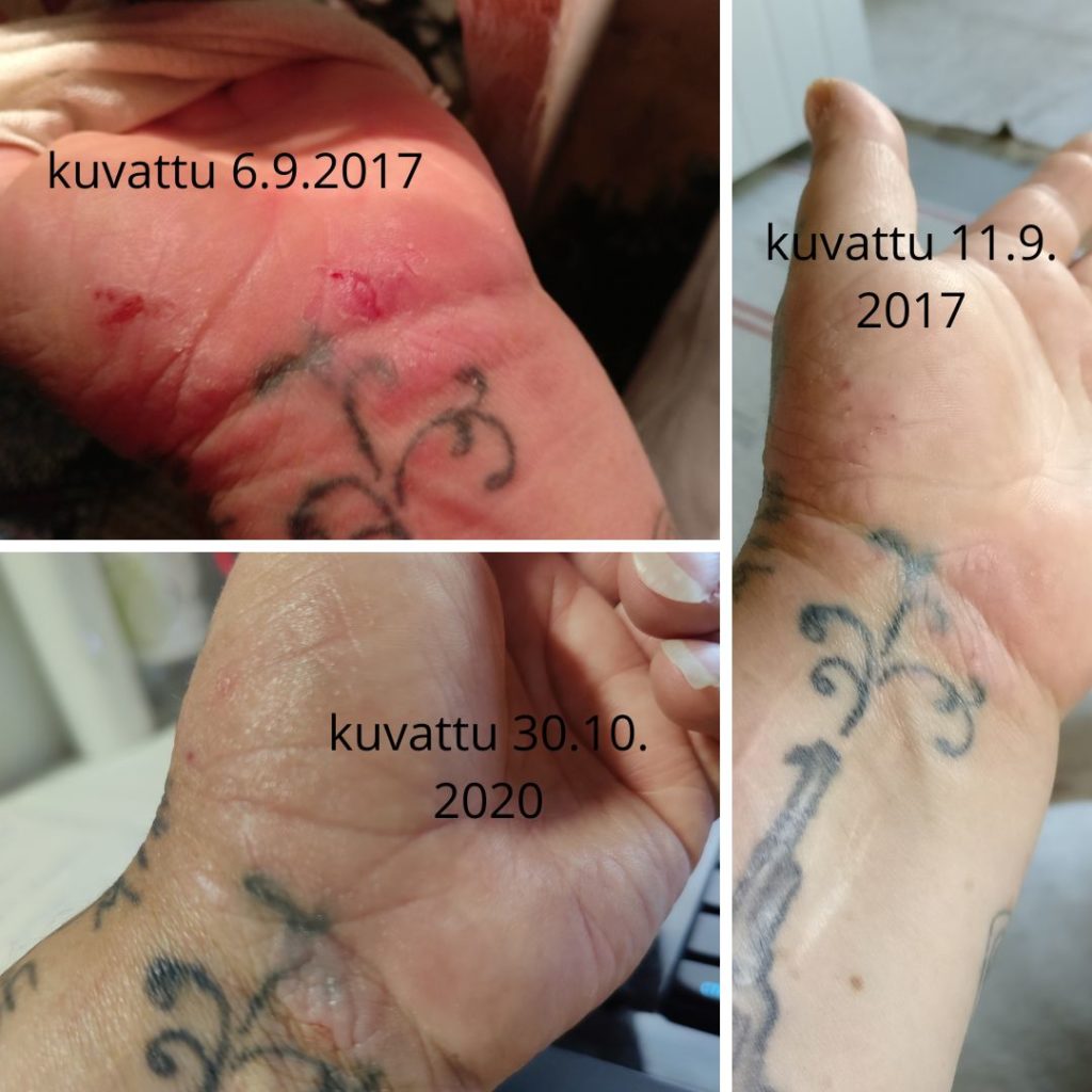 Pysyviä tuloksia Saaren Taika Kamomilla sheavoiteella ja teepuusaippualla vaikean käsi ekseema ihottuman hoidossa ennen ja jälkeen kuvia