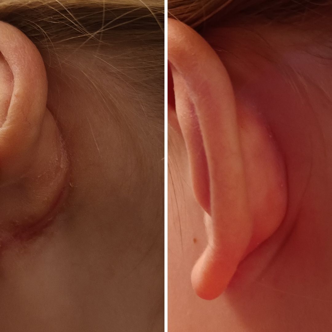 Atooppisen ihon kosteutukseen Sheavoi Karitevoi. Saanut kovin kuivan ihon kuriin, mikä villiintyi keväällä sairastelukierteen takia lapsella, erilaisten tulehdusten takia. On kokeiltu monet voiteet, myös lääkärin määrääminä ja ajattelin nyt laittaa tämän kovaan testiin ja nyt näyttää, että ehkä meille löytyi hyvä tuote.