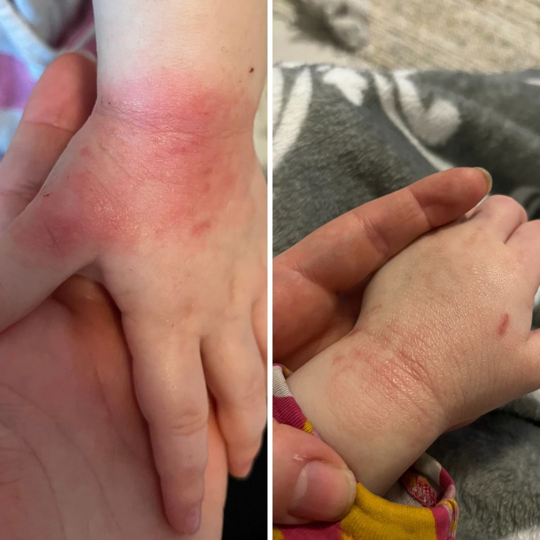 Pistin teille muutama viikko sitten kyselyä, löytyykö teiltä tuotteita mun rakkaan 2-vuotiaan pahaan atooppisen ihottuman hoitoon. Olen käyttänyt varmaan satoja euroja hänen ihottuman hoitoon, mikään ei tuntunut helpottavan ihoa kun hetkeksi ja taas menee pahaksi iho. Ennen teidän yhteydenottoa iho meni todella punaiseksi, kuoriutui iho, haavaiseksi raapimisen jäljiltä ja yöt meni raapiessa ihoa. Aloin olemaan todella surun murtama, kun näki että pienellä sattuu. Hän itki kun laittoi rasvaa tai kasteli vedellä. Päätin että kokeilen teidän tuotteita, ennen kuin menen uudestaan lääkäriin asian suhteen. Ostin kokeiluun ihottumaan Sheavoi Karitevoidetta sekä Saariston suolasaippuaa. Parin käyttökerran jälkeen aloin nähdä ihon parantumisen prosessin käynnistyvän. Kova pakkanen toi hiukan takapakkia ihottuman selättämiseen, mutta iho alkoi mennä parempaan suuntaan. Kiitos kiitos teidän tuotteiden, lapsi ei enää raavi käsiä öisin ja alkaa ihottuma alueen tilalle alkaa näyttää normaalilta iholta!! suolasaippuaa ei ärsytä ollenkaan hänen ihoa ja iho on aina sen käytön jälkeen ihanan pehmeä. Shea voidetta on ihana käyttää ja lapsi ei enää itke rasvan laiton aikana. Olen todella onnellinen, että teidän tuotteet auttoi pientä rakastani. Kiiitos! Laitan kuvat lapsen käsistä. Ensimmäinen kuva on joulukuusta, harmi kun en halunnut ottaa kuvia hänen ihottumasta silloin kun iho oli tosi rajun näköinen. Toinen kuva on otettu 2 viikon käytön jälkeen.