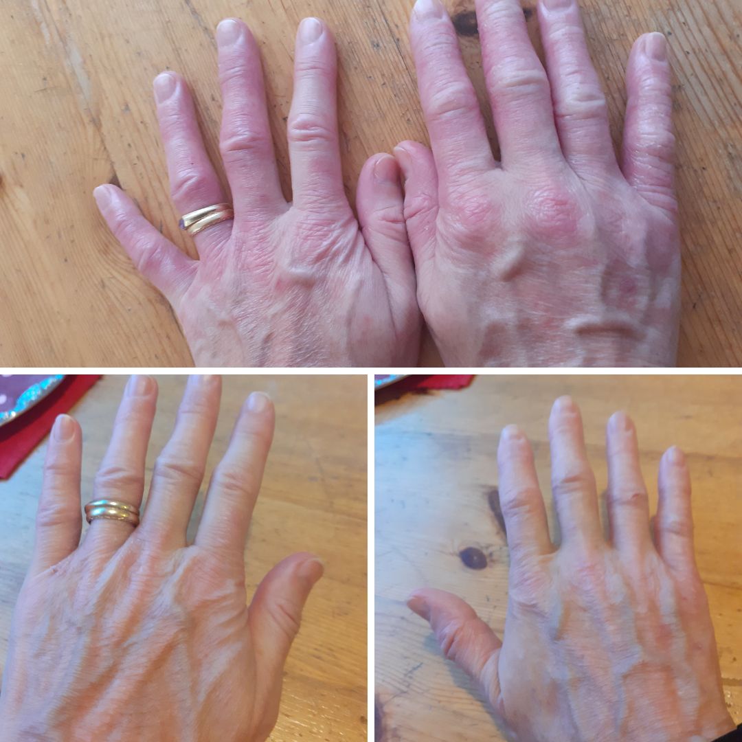 Saaren Taika Ravitseva käsi- ja kynsivoiteella apu atooppiseen ihottumaan punoitukseen kutinaan