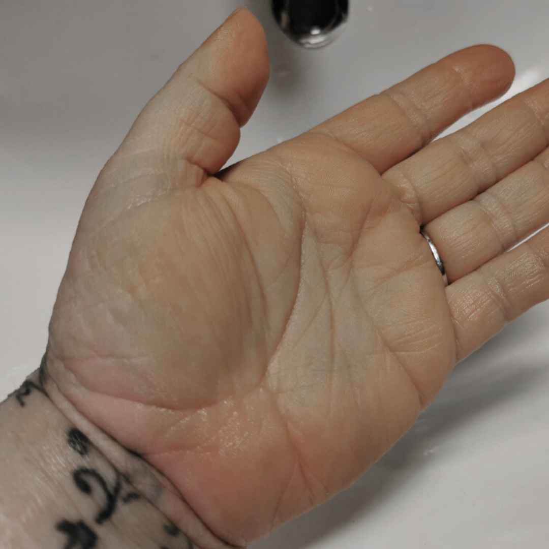 Kuva Johanna kädestä, jossa ei enää ole ihottumaa
