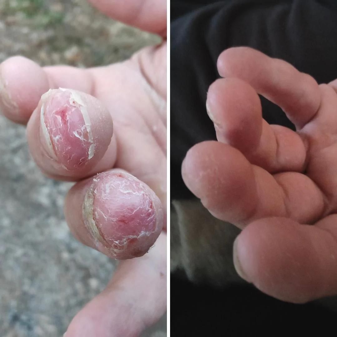 Mieheni kärsii käsi-ihottumasta, joka pahenee käsidesin tai kaupan käsisaippuoiden käytöstä. Kuvissa auki kuoriutuneet sormenpäät, joiden iho parani kuntoon noin viikon päivittäisellä Kamomilla Sheavoiteen käytöllä sekä nestemäiseen Saaren Taika Teepuusaippuaan vaihdettaessa!